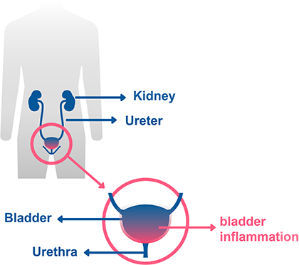 Cystitis