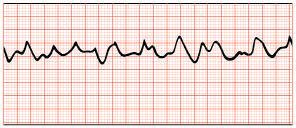 Myocardial infarction