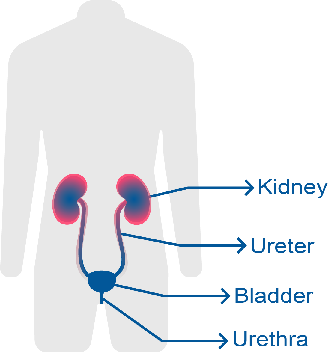 pyelonephritis